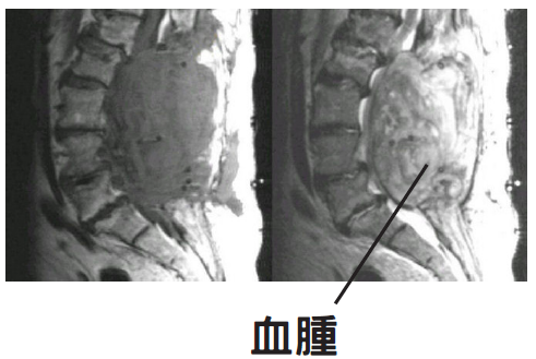 微創椎間盤切除手術